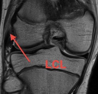 LCL MRI Insertion